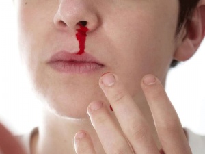 Почему идет кровь из носа? Как ее остановить?